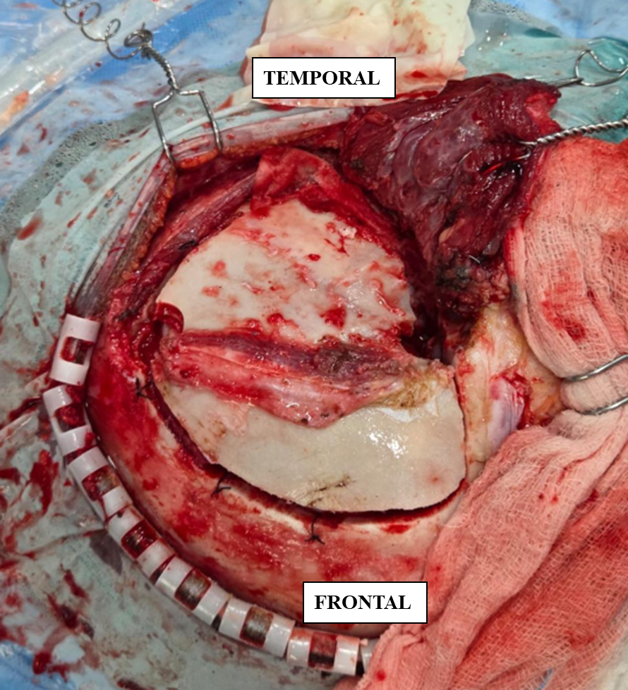 Figure 6. Harvested graft- parietal branch of superficial temporal artery.]